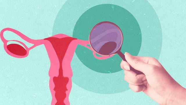 Các cách điều trị bệnh ung thư buồng trứng điển hình