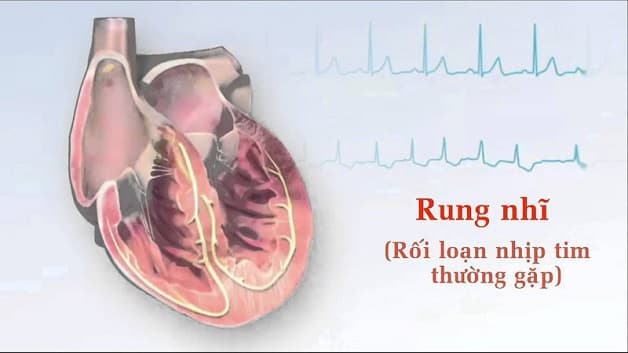 đột quỵ não do rung nhĩ (bệnh tim mạch)