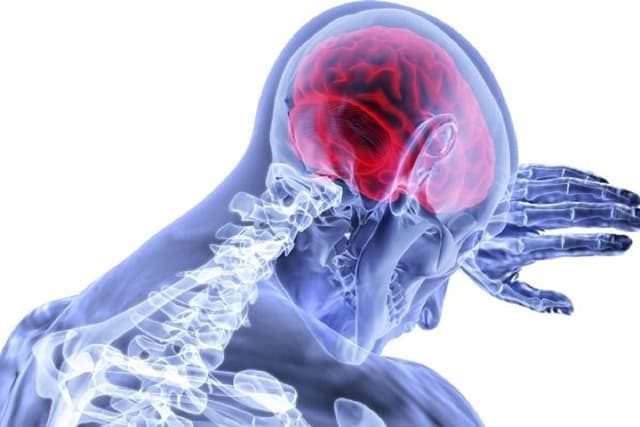 Đột quỵ xuất huyết não đang trẻ hóa