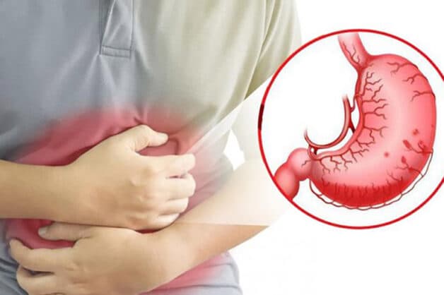 Người bệnh mắc viêm dạ dày phần lớn do lạm dụng các thuốc giảm đau, chống viêm NSAID hoặc nhiễm vi khuẩn hp dạ dày.