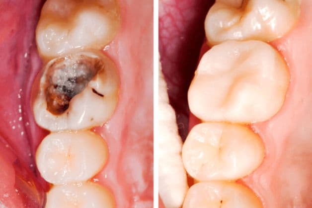 Lưu ý gì khi hàn răng trẻ em?