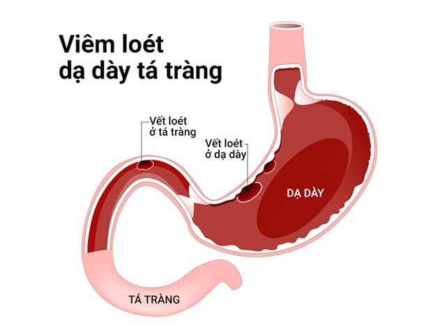 phòng ngừa hiện tượng đau dạ dày tá tràng