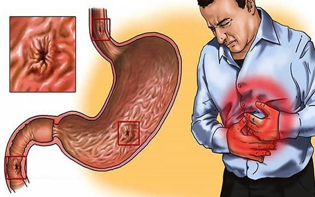 Hiện tượng viêm loét dạ dày gây đau