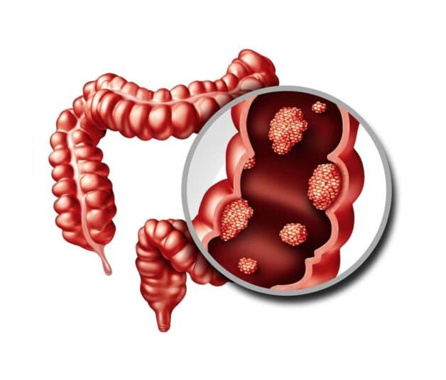 Giải đáp những thắc mắc về hóa trị liệu ung thư dạ dày