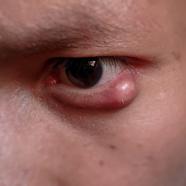 lẹo ở mắt