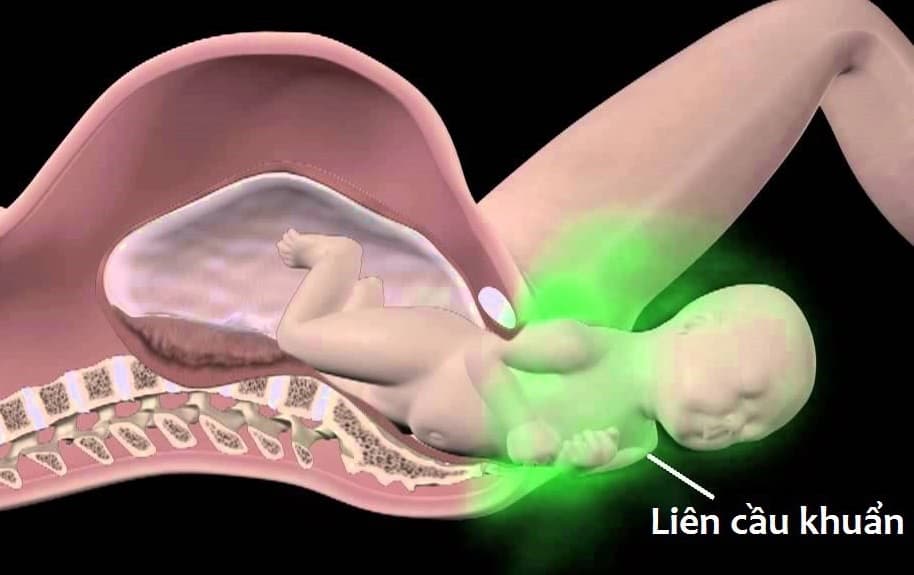 Liên cầu khuẩn nhóm B có thể gây ra những biến chứng nhiễm trùng sơ sinh, gồm nhiễm trùng sơ sinh sớm hoắc nhiễm trùng sơ sinh muộn