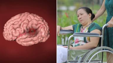 Liệt nửa người do nhồi máu não phục hồi như thế nào? 