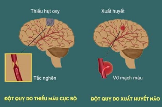 mất ngủ quá lâu dễ gây đột quỵ (tai biến mạch máu não)
