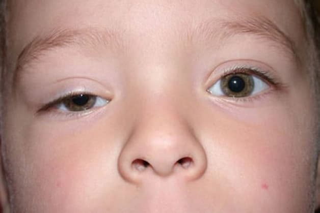 mí mắt bị sụp