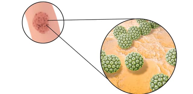 4 điều quan trọng về mụn cóc sinh dục bạn cần biết