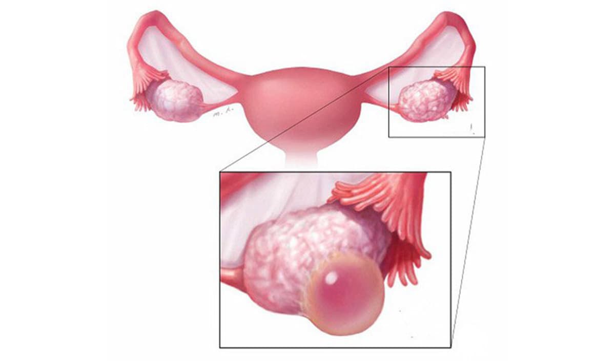 Nang nước buồng trứng, u nang buồng trứng có kèm biến chứng