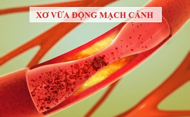Các yếu tố nguy cơ chung gây đột quỵ xuất huyết não