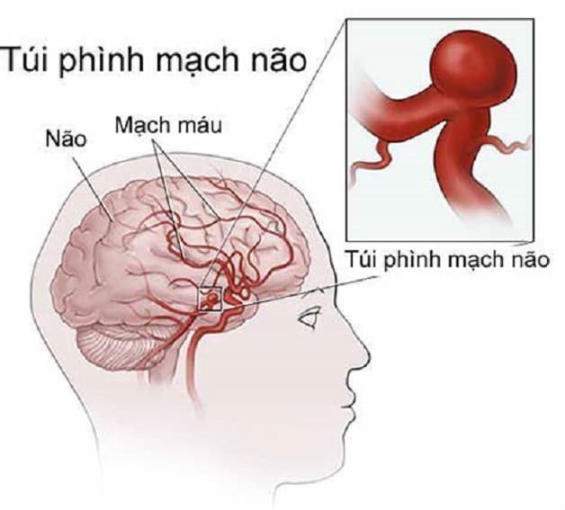 đột quỵ xuất huyết não do vỡ túi phình mạch não