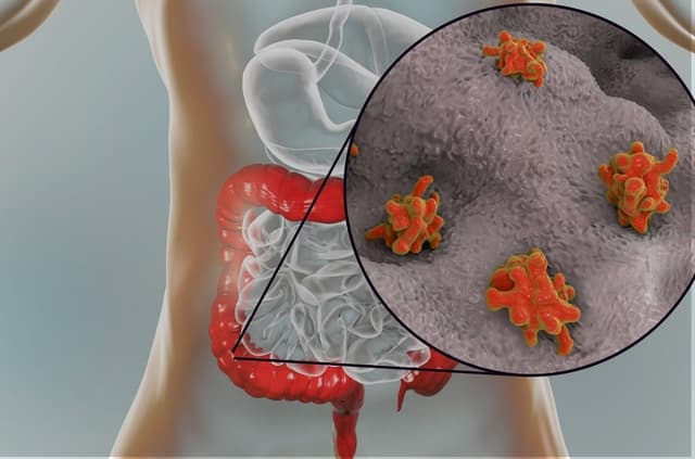 Nguyên nhân viêm đại tràng và giải pháp chẩn đoán