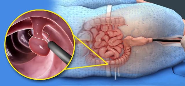 Nội soi cắt polyp đại tràng được thực hiện ra sao?