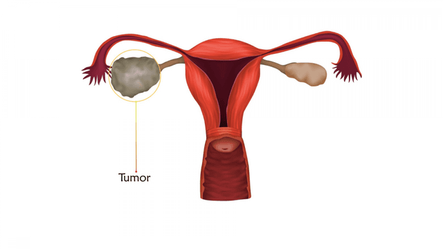 Tìm hiểu phác đồ điều trị ung thư buồng trứng