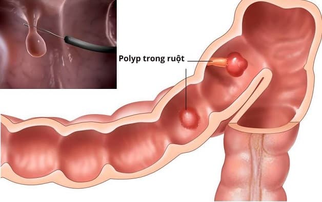 khối polyp đại tràng nghịch sản
