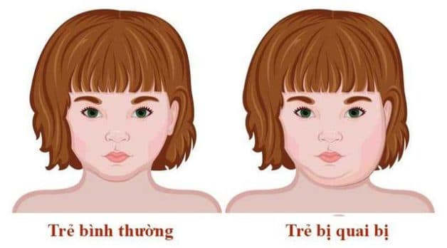 Trẻ mắc quai bị bị sưng tuyến nước bọt mang tai