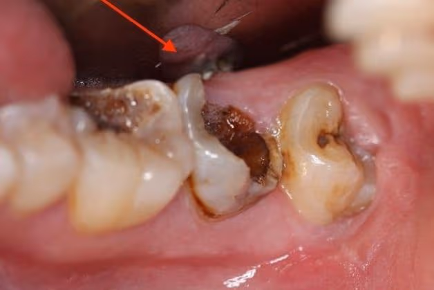 Vì sao răng số 7 bị sâu vỡ?