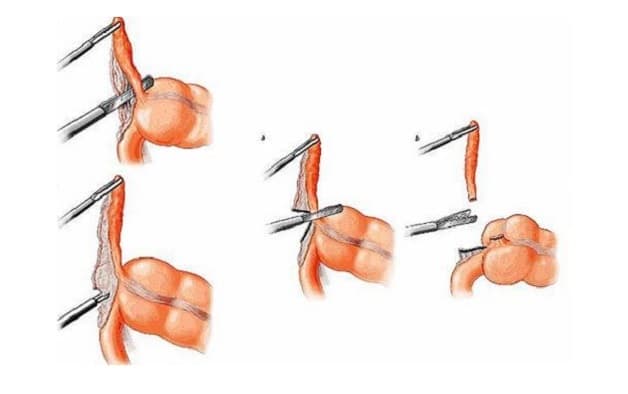 điều trị viêm ruột thừa