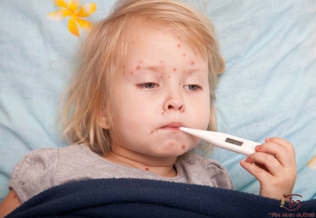 sởi đơn và sởi quai bị rubella khác nhau