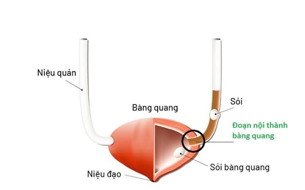 Sỏi nội thành bàng quang là sỏi gì và cách điều trị