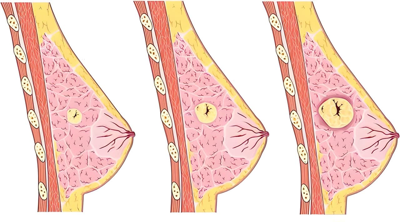 Tắc tia sữa là tình trạng sữa mẹ không thể chạy ra ngoài được do ống dẫn sữa bị hẹp hoặc bị tắc