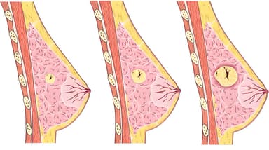 Tại sao mẹ bị tắc tia sữa ra máu? Khi bị như vậy phải làm sao?