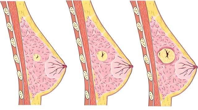 Tại sao mẹ bị tắc tia sữa ra máu? Khi bị như vậy phải làm sao?
