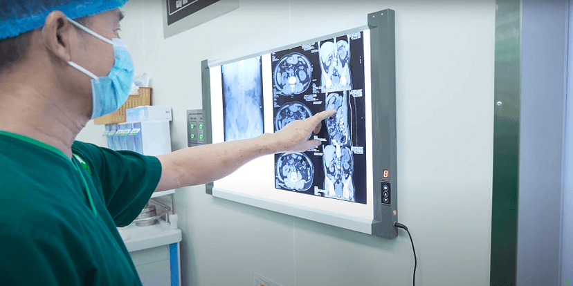 Làm sạch đồng thời 2 viên sỏi niệu quản tái phát gây tắc nghẽn: Không mổ mở, không đau