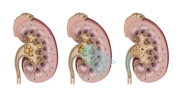 Giải đáp thời gian thực hiện tán sỏi mất bao lâu?