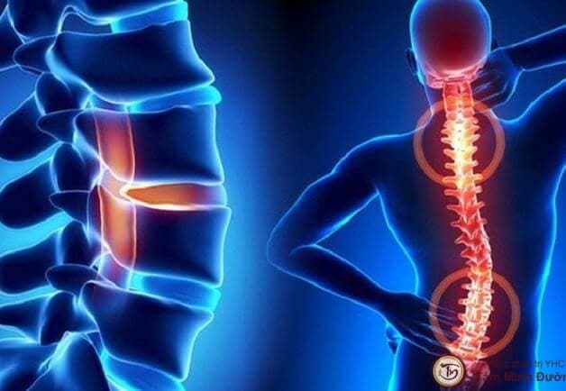 Thoái hóa cột sống cổ và thắt lưng