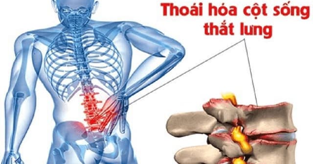 Cách điều trị thoái hóa cột sống lưng và các lưu ý cần thiết