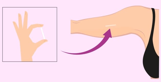 thời điểm cấy que tránh thai là bao giờ