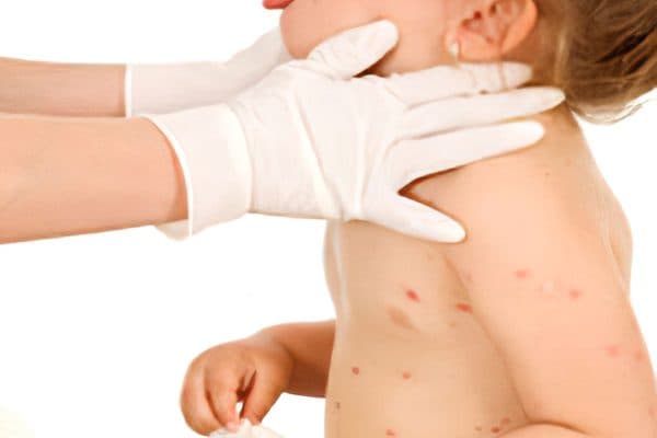 Thủy đậu là bệnh lý thường gặp ở trẻ vào thời điểm giao mùa, có thể lây lan