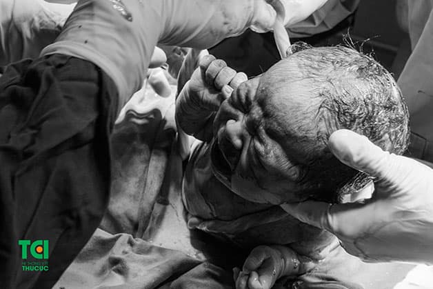 Em bé chào đời với 2 vòng dây rốn quấn cổ