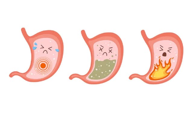 Điểm danh triệu chứng ung thư dạ dày giai đoạn đầu