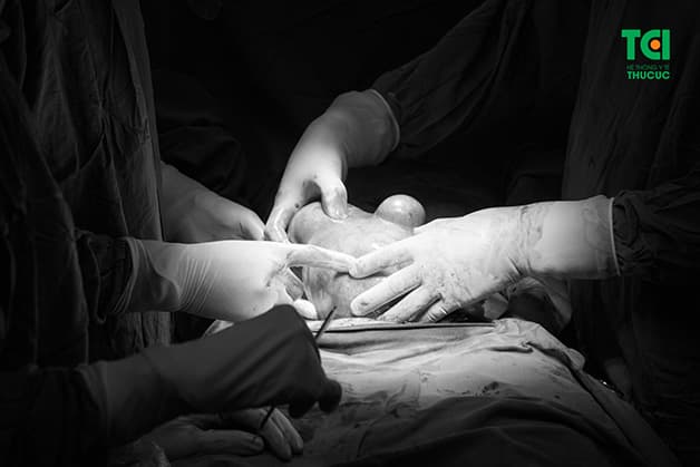 Phụ nữ trong độ tuổi sinh sản, thay đổi, rối loạn hệ nội tiết khiến u xơ tử cung dễ xuất hiện, tiến triển và dẫn tới nhiều biến chứng