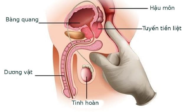 Tổng hợp thông tin cần biết về ung thư tuyến tiền liệt