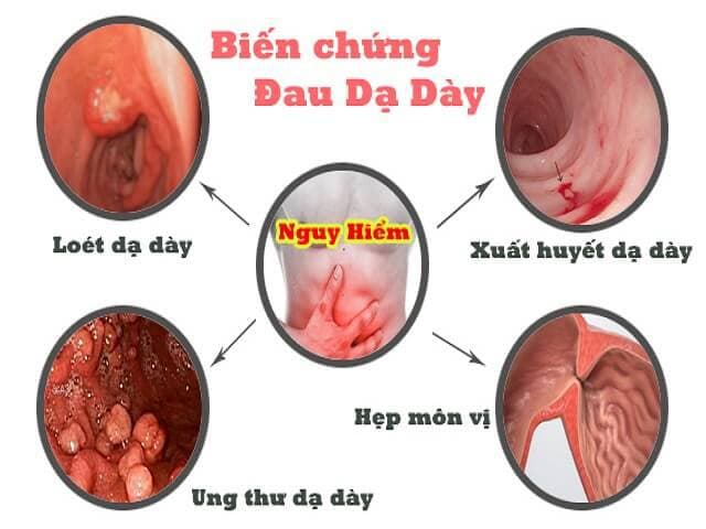 biến chứng Viêm dạ dày nặng