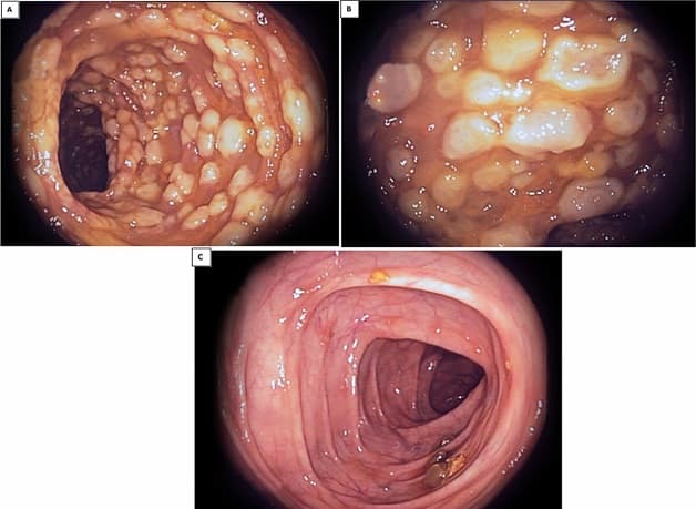 Tìm hiểu viêm đại tràng giả mạc là gì