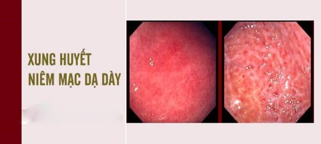 Viêm loét dạ dày có mấy cấp độ? Bệnh được chia thành 4 cấp độ