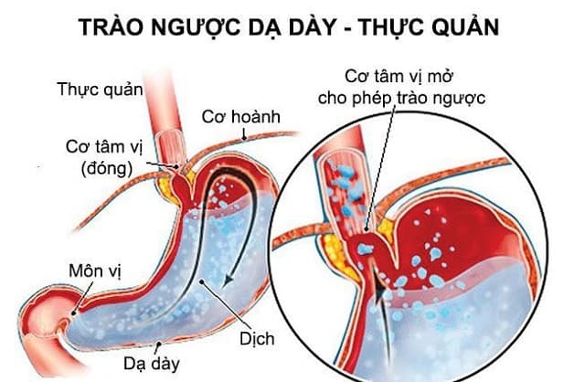 viêm loét trào ngược dạ dày có liên quan không