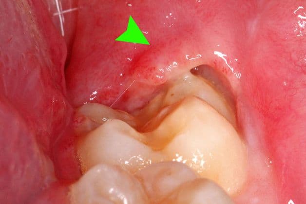 Dễ dàng nhận biết bệnh lý viêm lợi trùm chân răng.