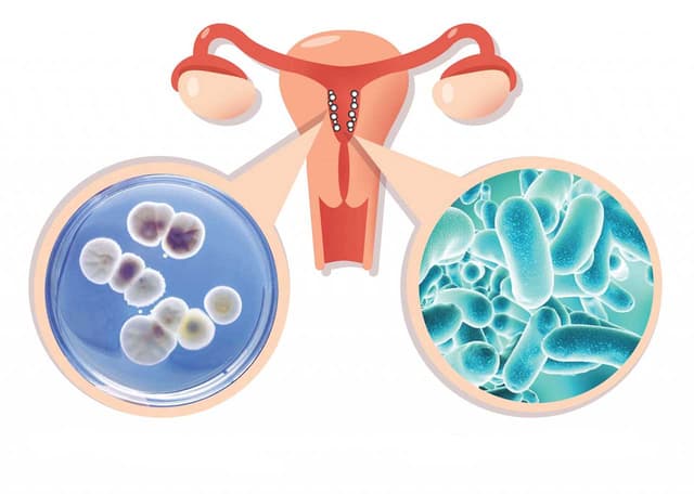 Các dấu hiệu viêm nhiễm phụ khoa “nhìn qua cũng biết”