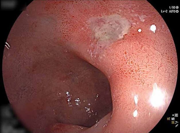 Viêm niêm mạc dạ dày hành tá tràng
