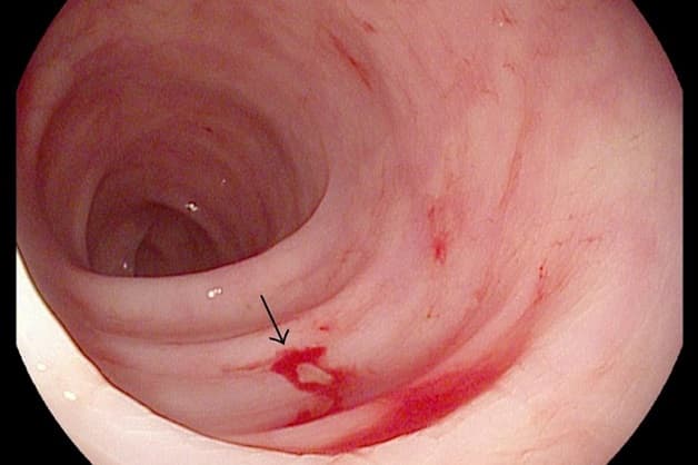 Viêm sưng hang vị có thể dẫn tới xuất huyết tiêu hóa