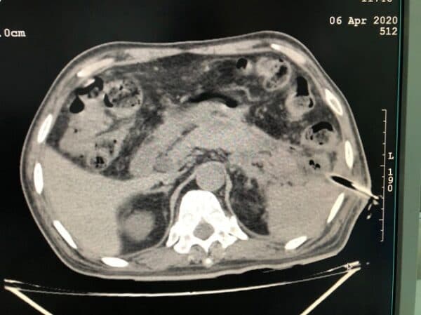 Nguyên nhân viêm tụy cấp bắt nguồn từ thói quen ăn uống, sinh hoạt 