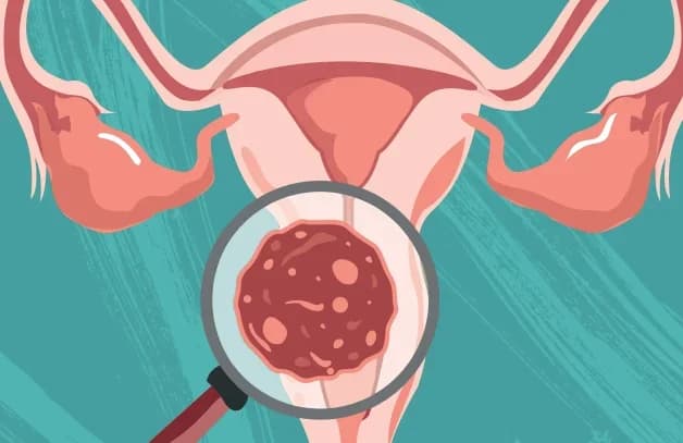 Tầm soát ung thư cổ tử cung khi nào