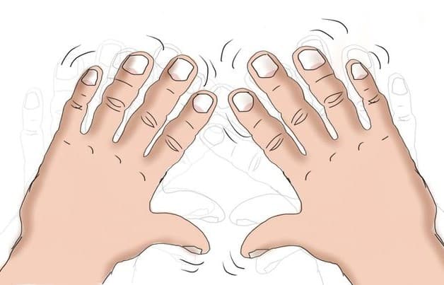 Run vô căn - một trong những trường hợp của bệnh rối loạn vận động